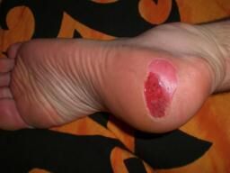 Article : Comment éviter les ampoules lors de randonnées au long cours